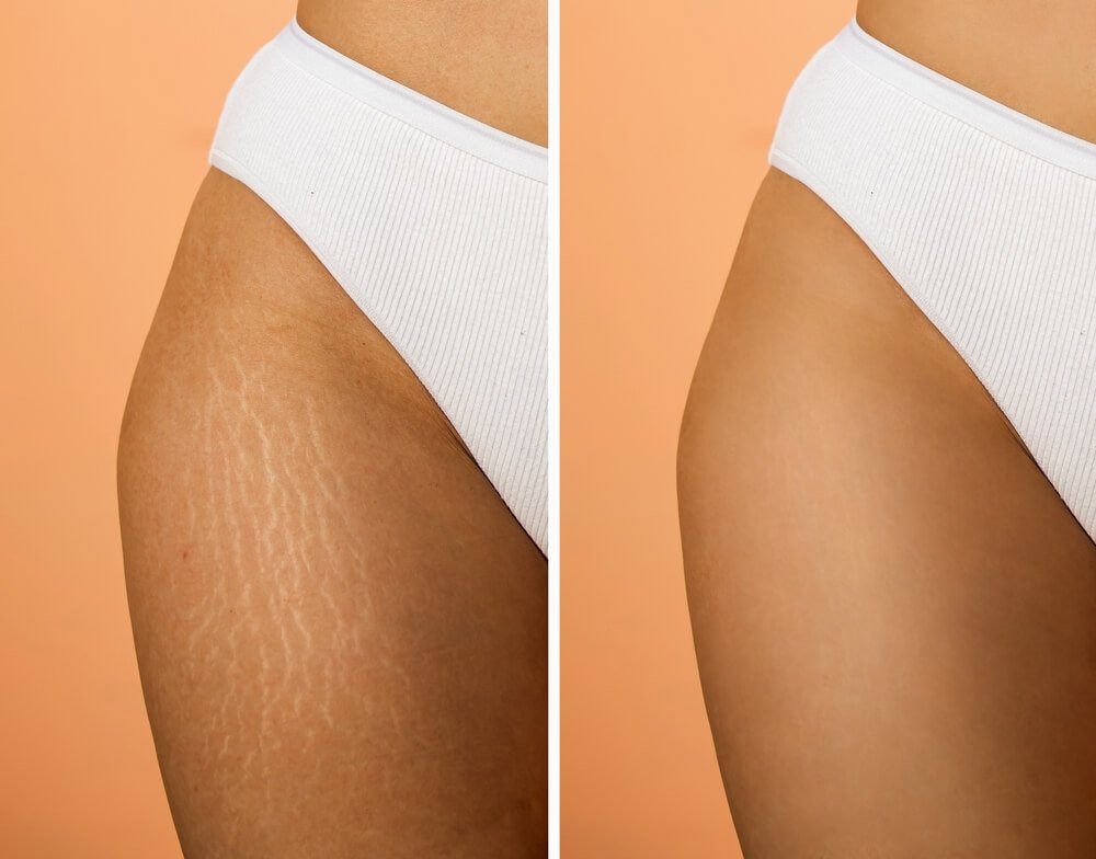 Stretch Mark Treatment