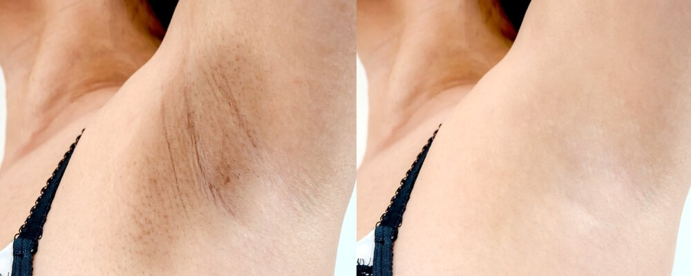 underarms