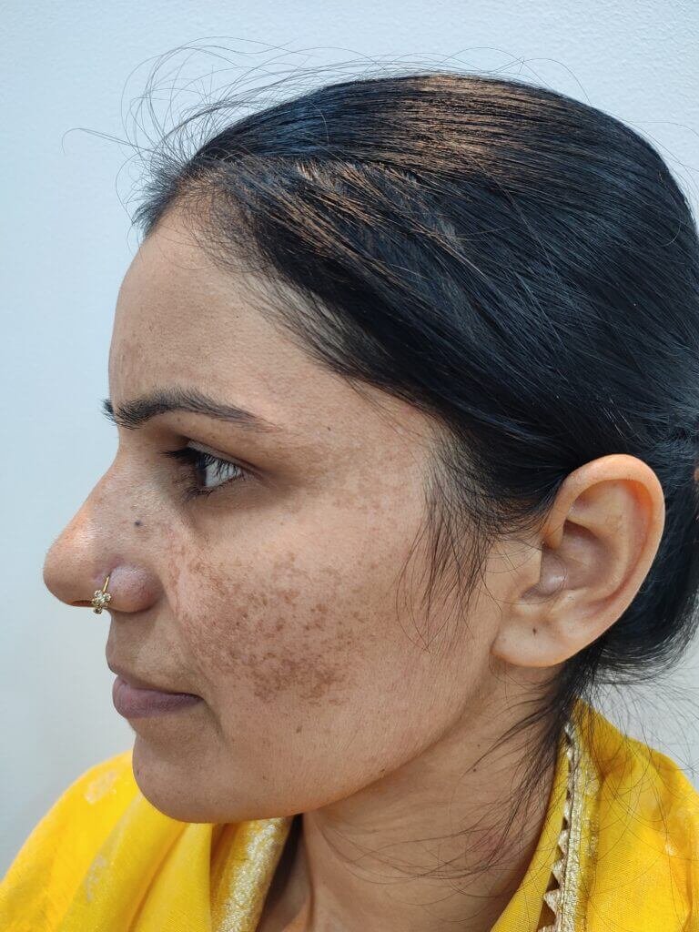 Best Melasma Treatment in Faridabad