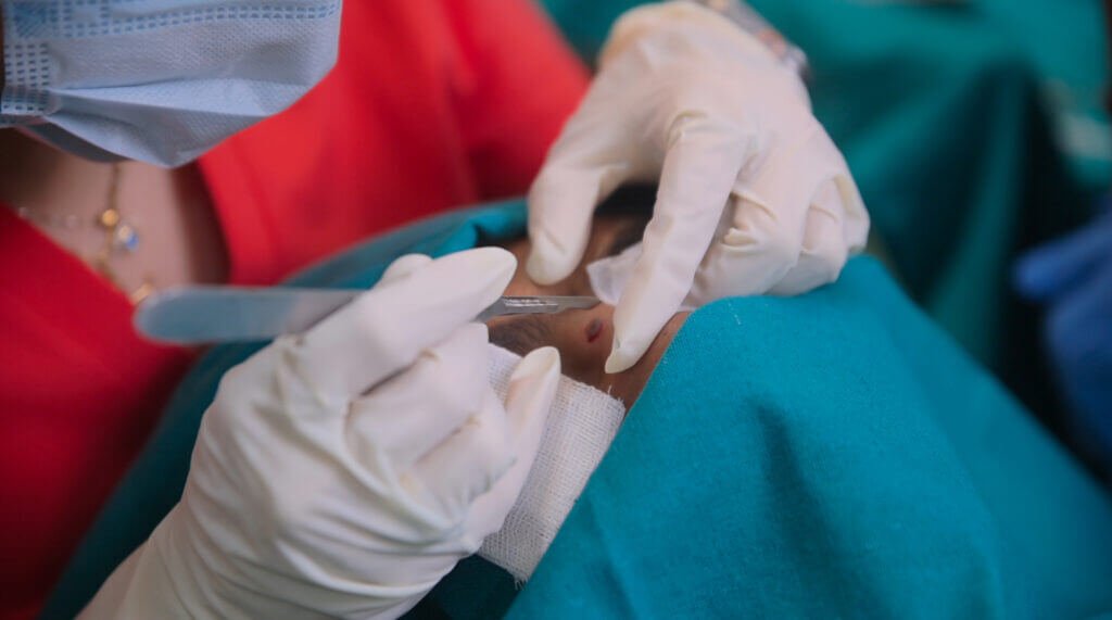 Mole & Wart Removal Treatment in Delhi NCR