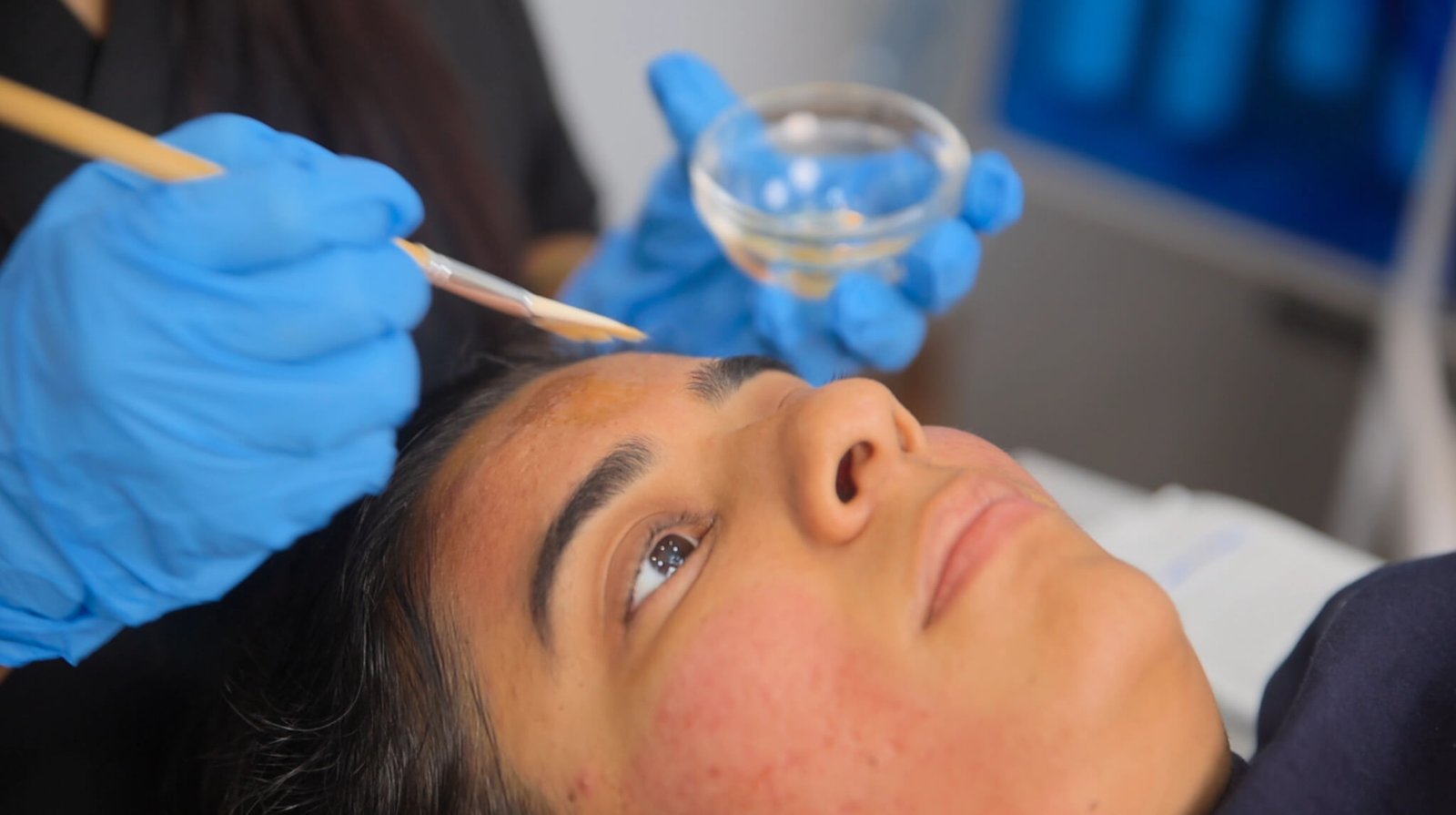 chemical peel