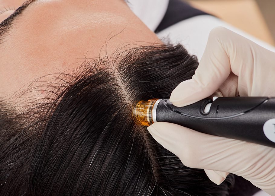 Keravive for Hair Loss Treatment