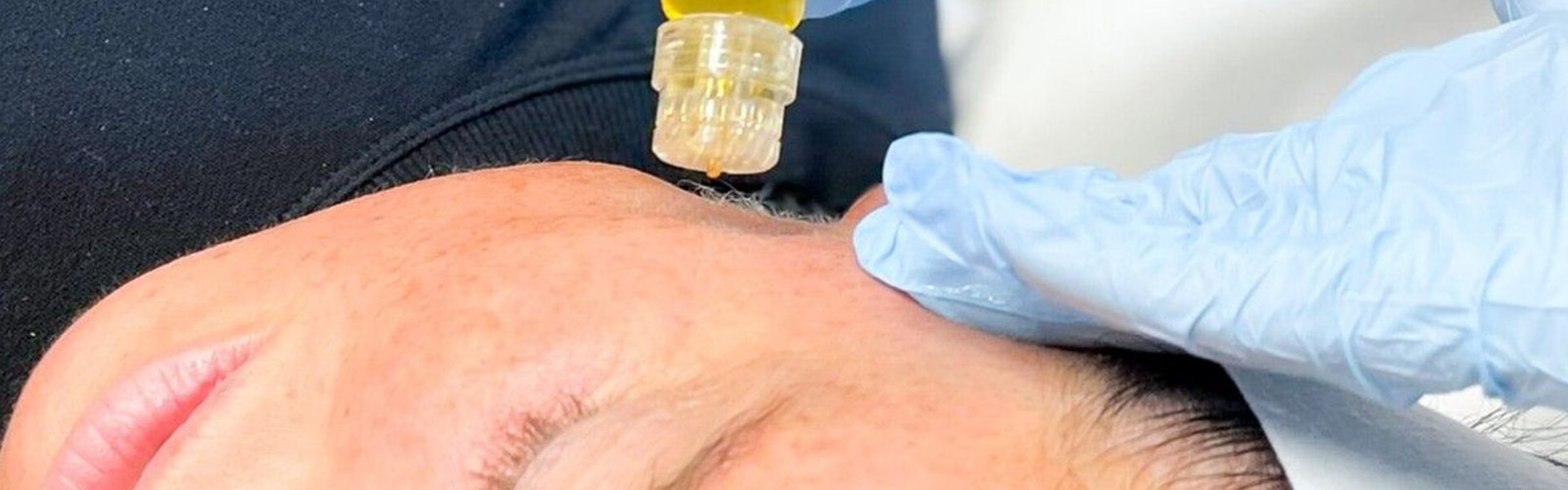 aquagold facial