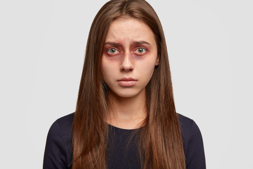Best Dark Circles Removal Treatment