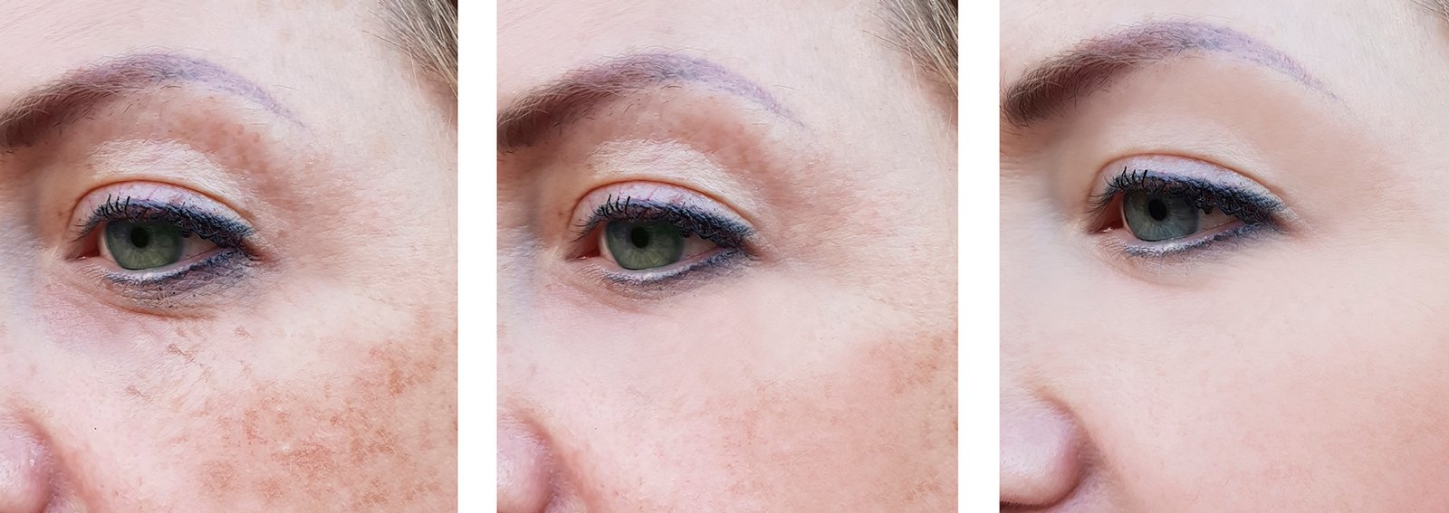pigmentation