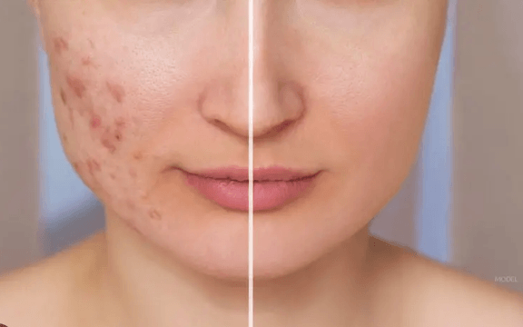 acne scar treatment in faridabad