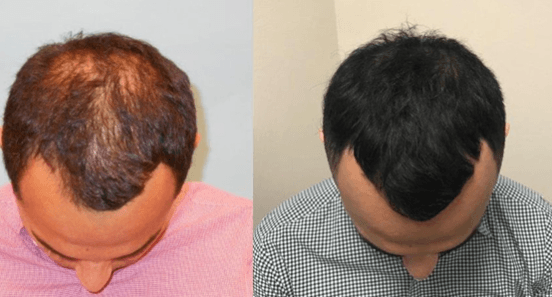 hair prp treatment before and after
