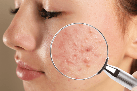 acne treatment
