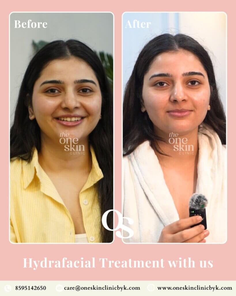 Hydrafacial treatment