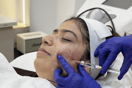 Skin Booster Treatment